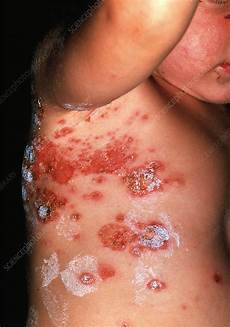 Bacteria